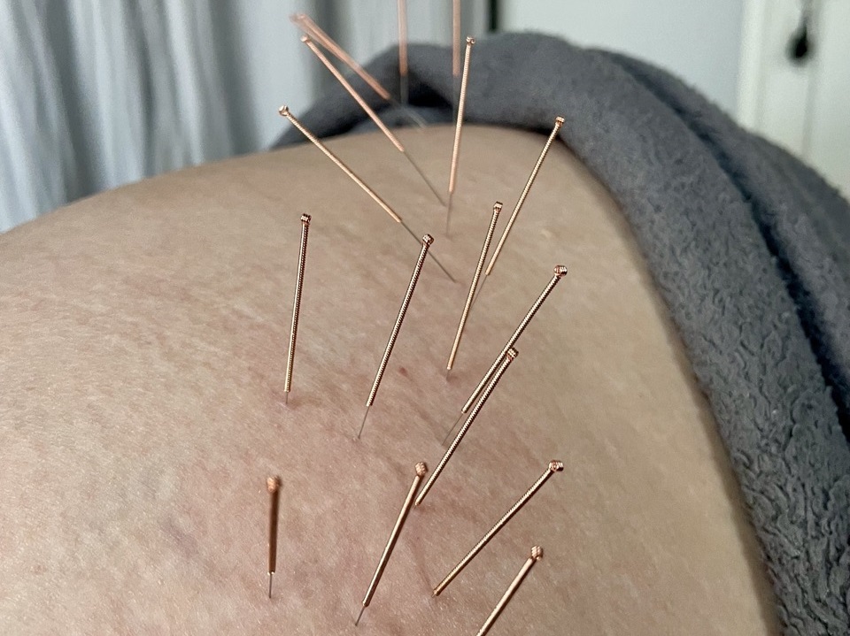 Acupuncture